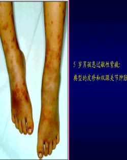 过敏性紫癜遗传吗??过敏性紫癜会遗传吗-第1张图片-