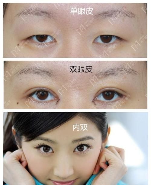 单眼皮可以变成双眼皮吗怎么才能变，不做手术那种