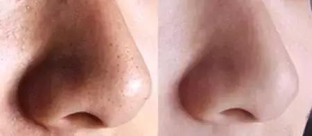 草莓鼻怎么治疗效果好 教你最有效的5个办法(4)