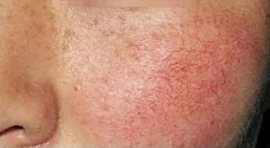 脸上有红血丝用什么最好（脸上有红血丝保养必看）(2)