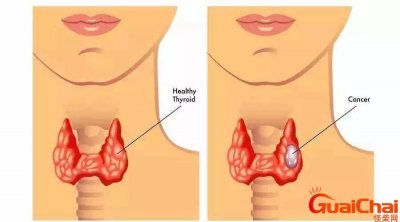 ​甲状腺结节是什么原因造成的怎么治疗？甲状腺结节是什么原因造成的中医解释