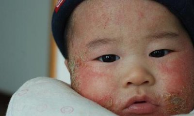 ​三个月宝宝脸上红红的很粗糙(婴儿脸上两边红红的还粗糙)